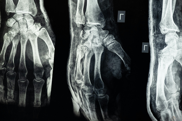 Personal Injury Lawyer Marietta, GA
